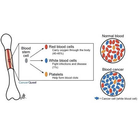 Complete Blood Count (CBC) | CancerQuest